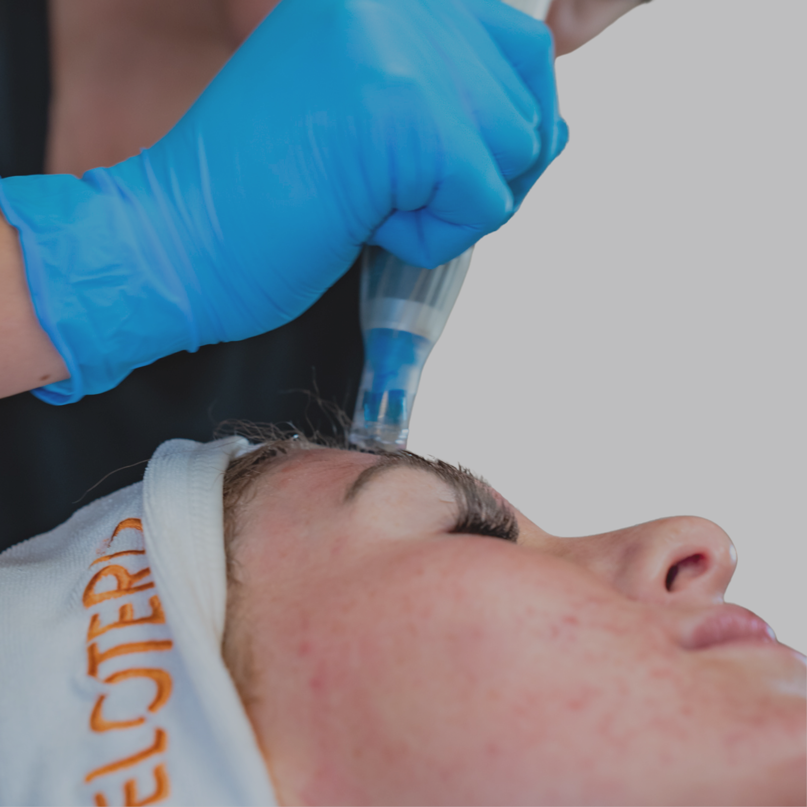 Microneedling